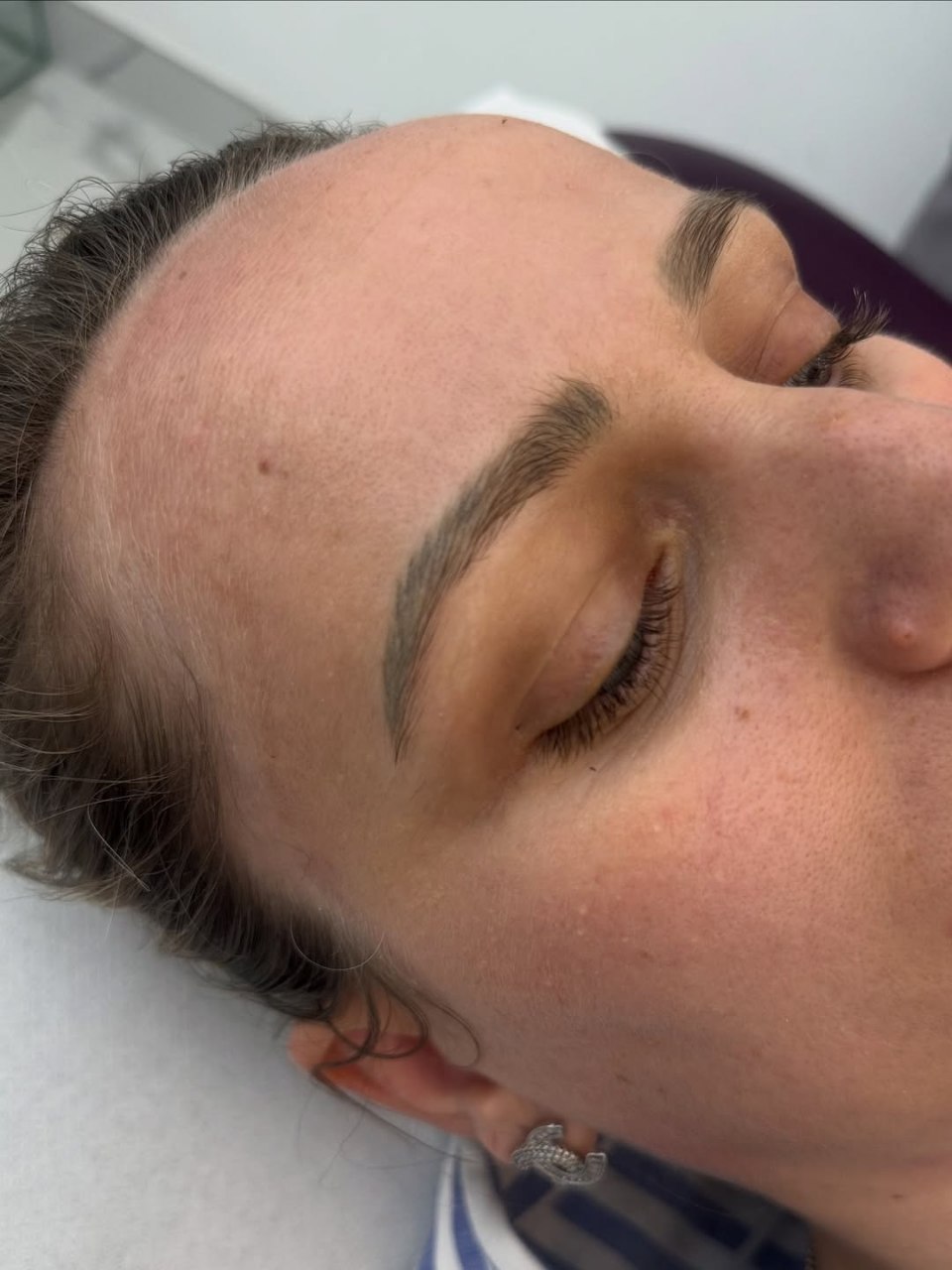 Brow Removal / Tattoo Removal After Treatment