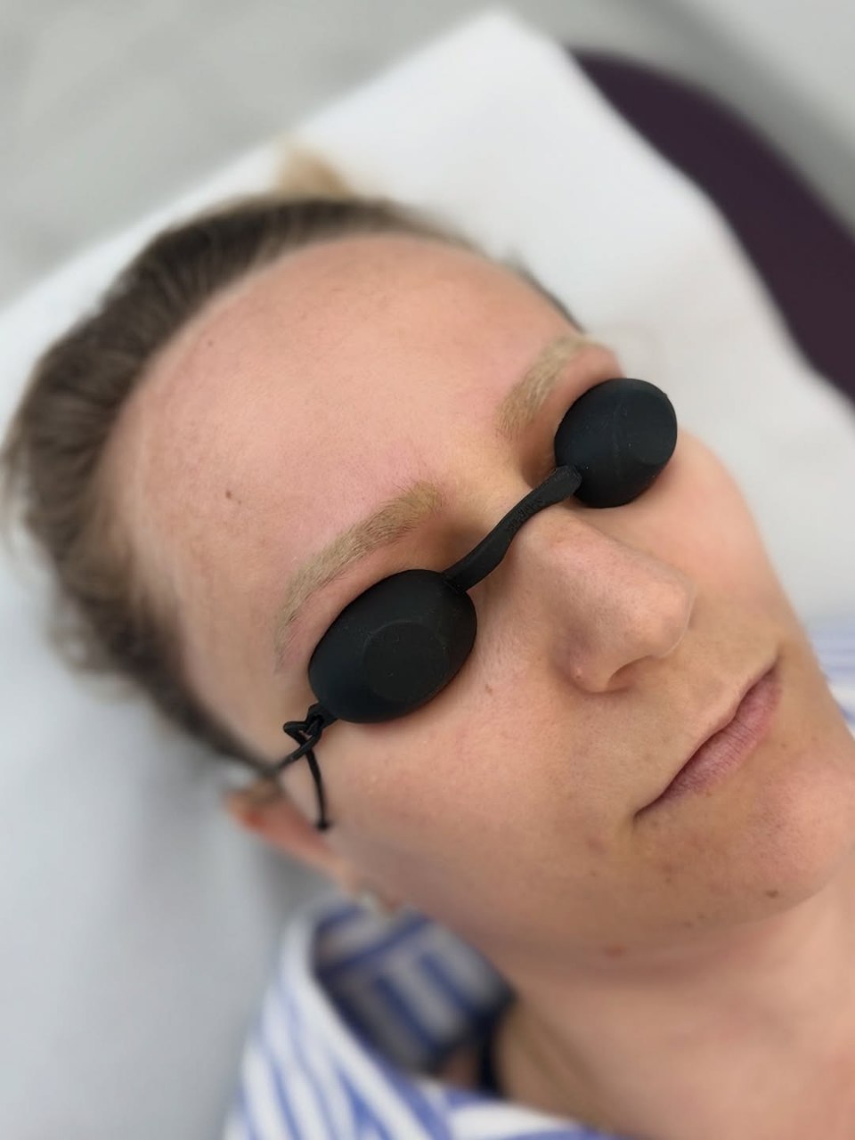 Brow Removal / Tattoo Removal Before Treatment