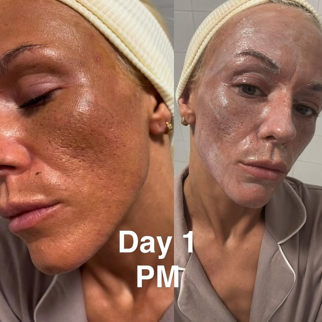 CO2 Laser Before Treatment
