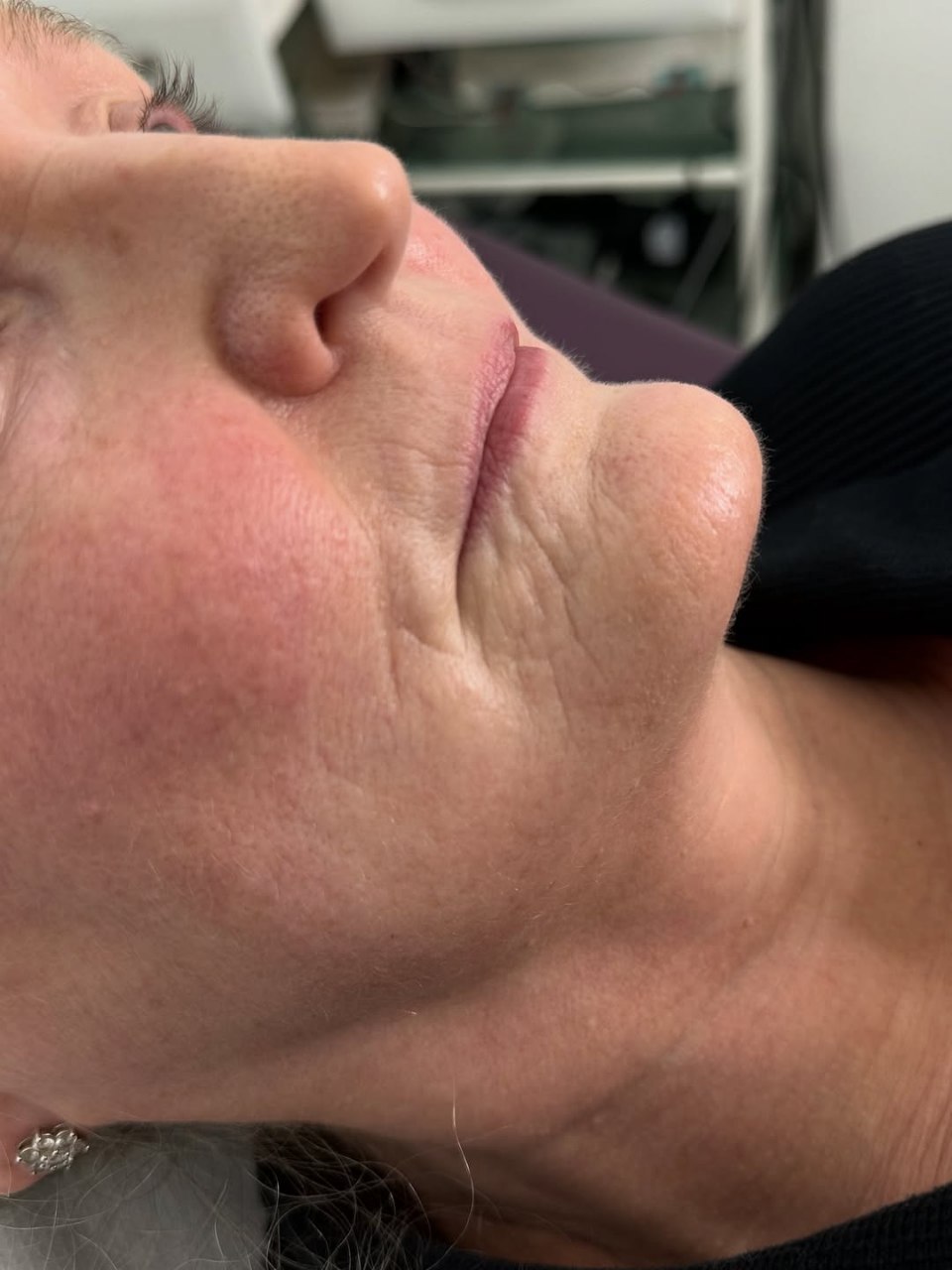 Dermal Filler After Treatment