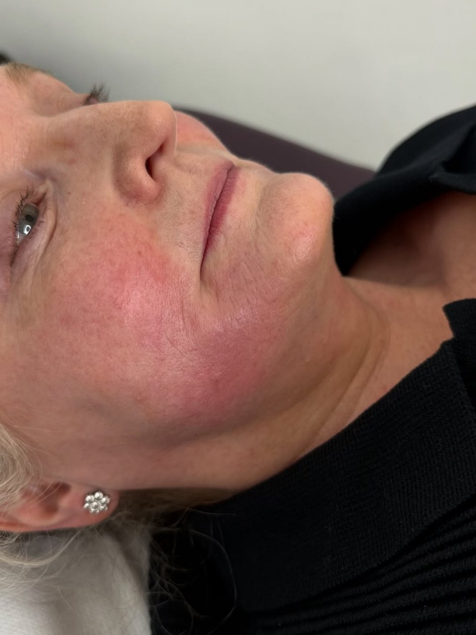 Dermal Filler Before Treatment