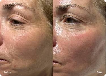Aquafacial & Skin Treatments