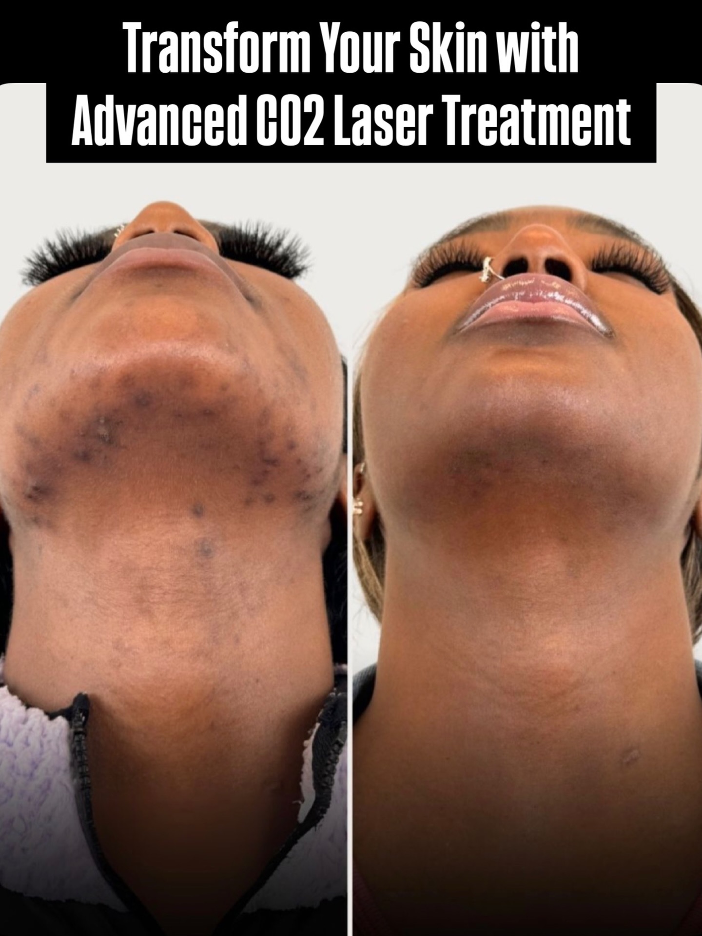 Co2 Laser and Skin Resurfacing